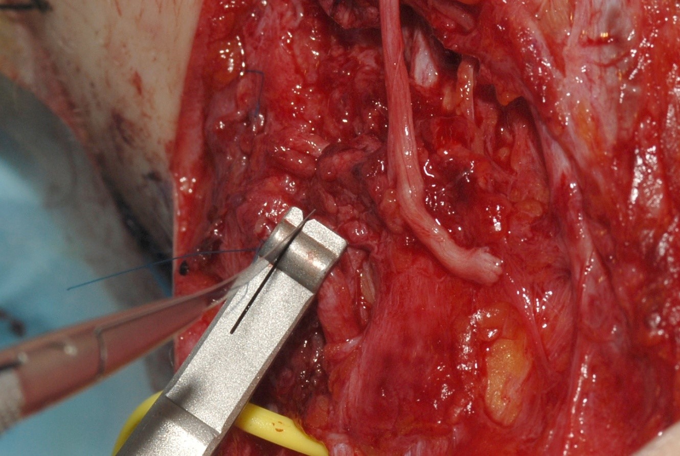 Photograph showing the Meyer nerve holding and trimming instrument being used to trim the end of a disrupted nerve before repair with a nerve graft