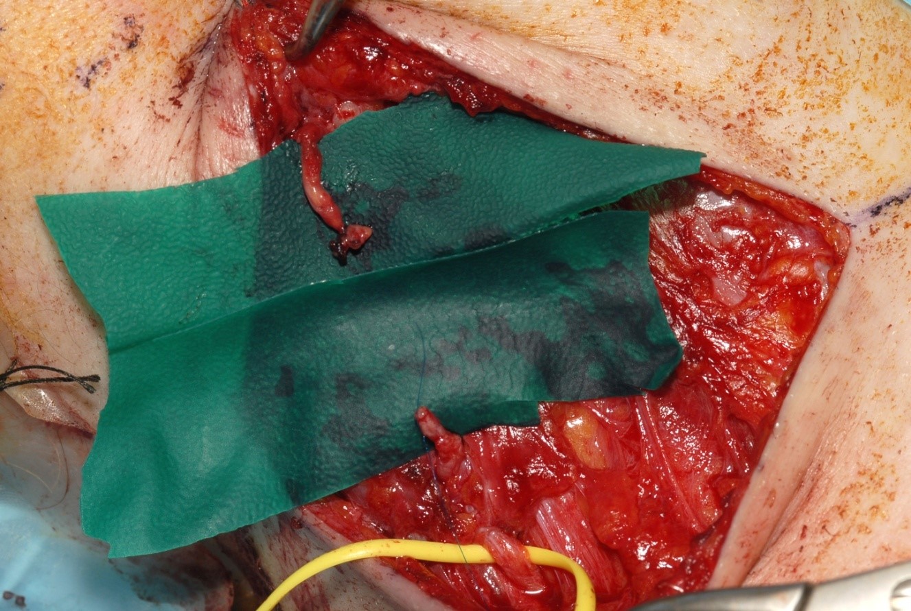 Delayed repair of a laceration of the Accessory nerve. Direct suture was not possible without excessive tension