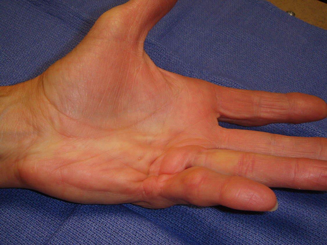 Figure 1a: Patient had interconnected central ring/little and little finger abductor cord, both with MP contractures.