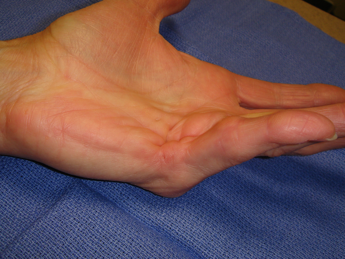 Figure 1b: Patient had interconnected central ring/little and little finger abductor cord, both with MP contractures.