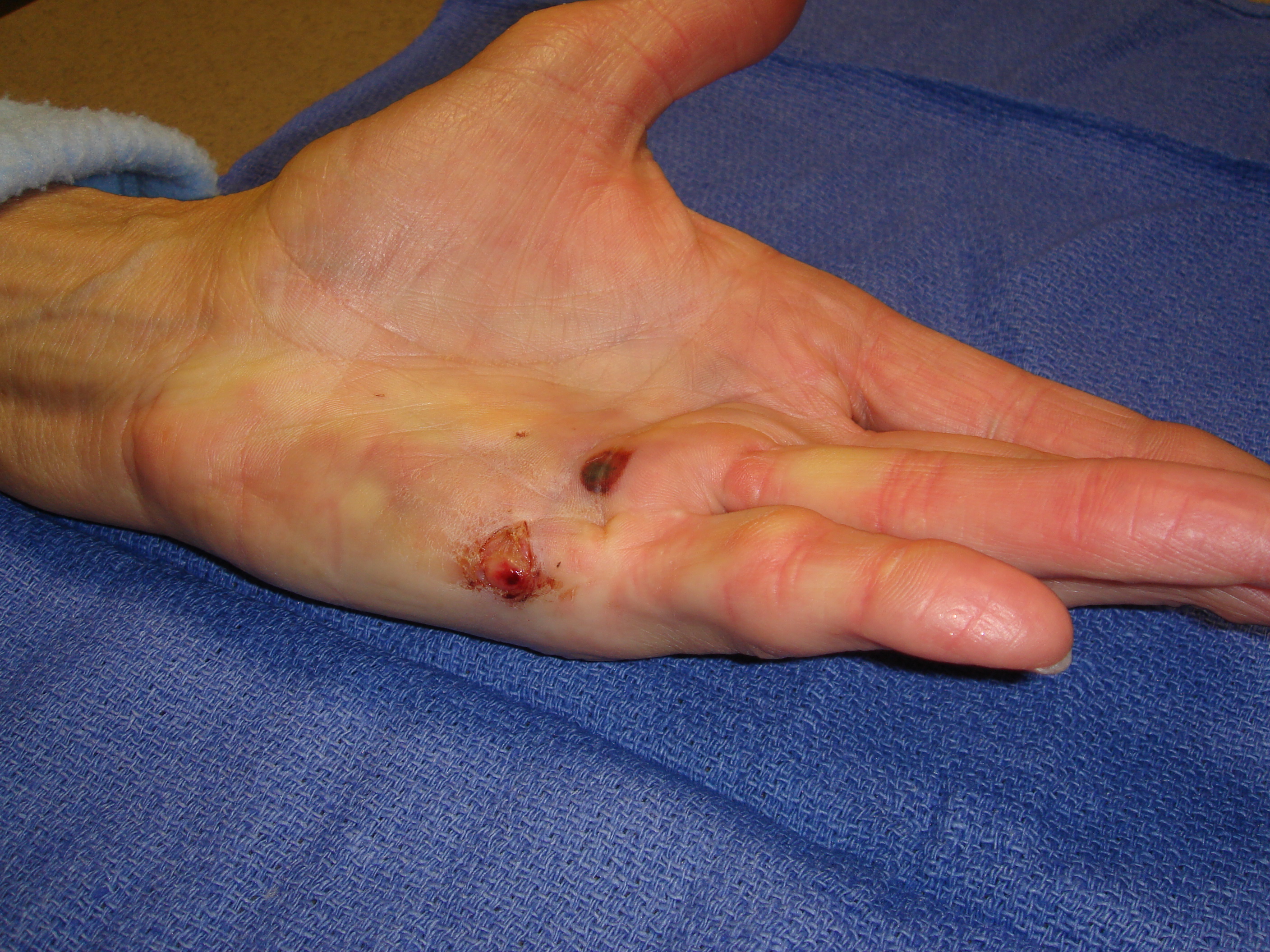 Figure 1c: The hand at 7 and 31 days post-injection; patient has been using a nighttime extension splint