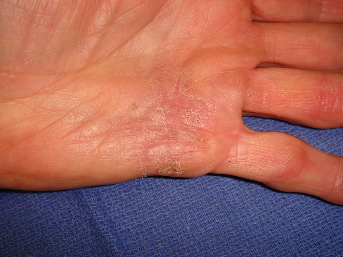 Figure 1d: The hand at 7 and 31 days post-injection; patient has been using a nighttime extension splint
