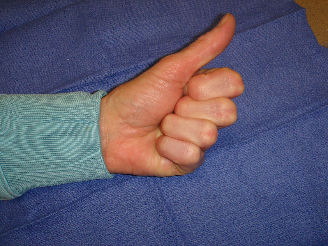 Figure 1e: The hand at 7 and 31 days post-injection; patient has been using a nighttime extension splint