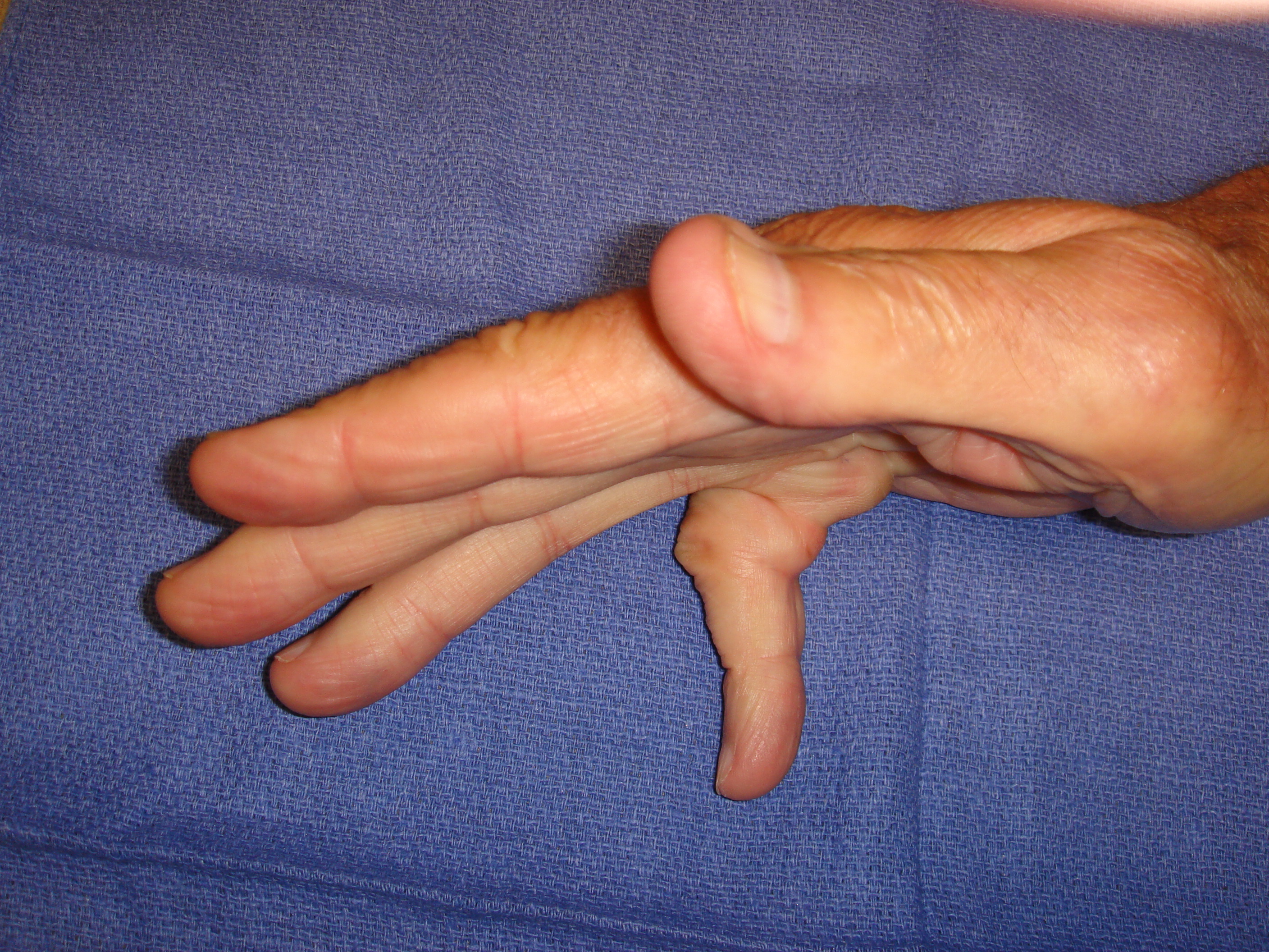 Figure 2b: This patient had a combined little finger MP and PIP contracture plus a Y-cord (natatory cord) into the ring finger.