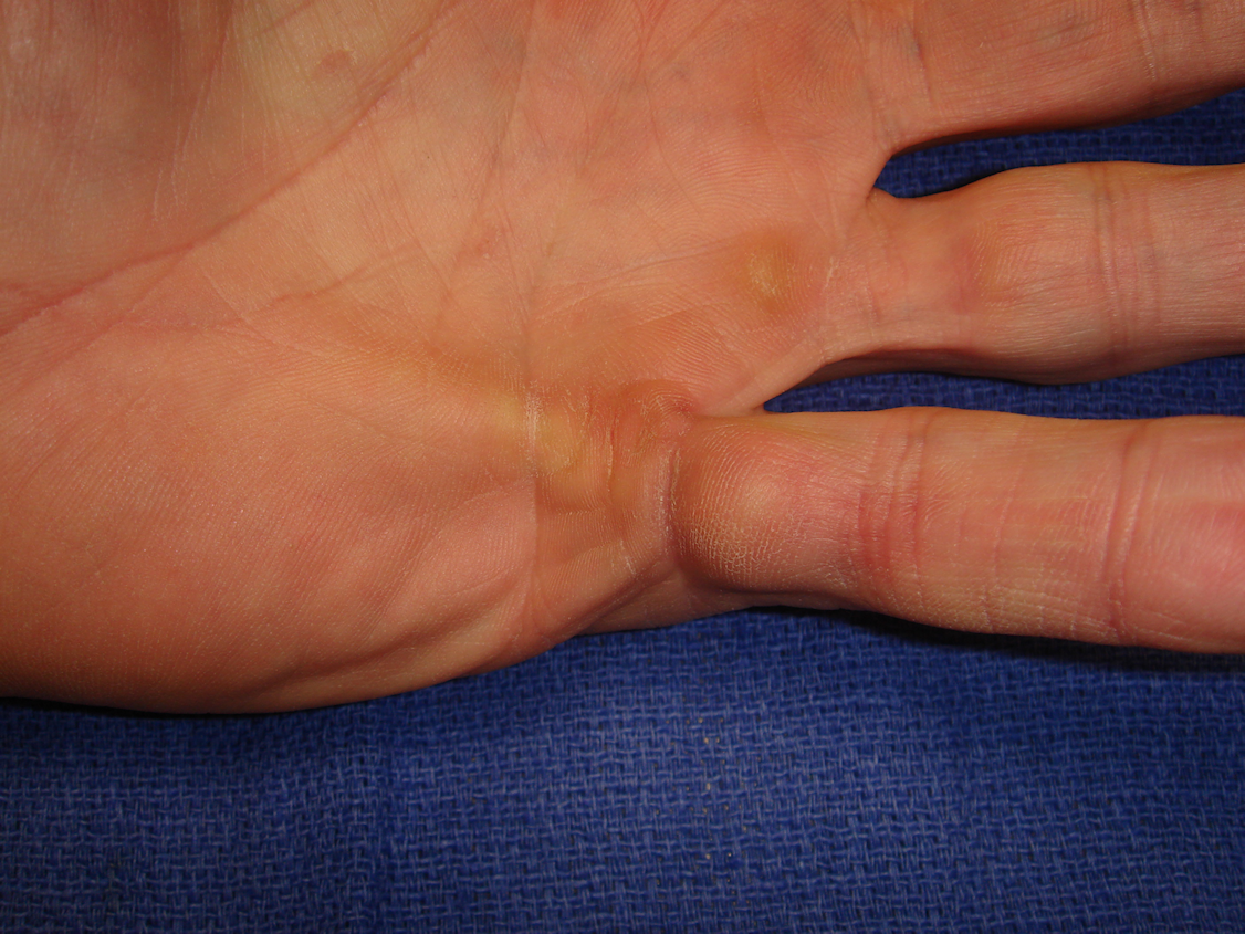 Figure 3a: This 46-year-old man has a strong family history of Dupuytren’s disease but without ectopic sites. There is contracture of the left fifth ray from a central cord.