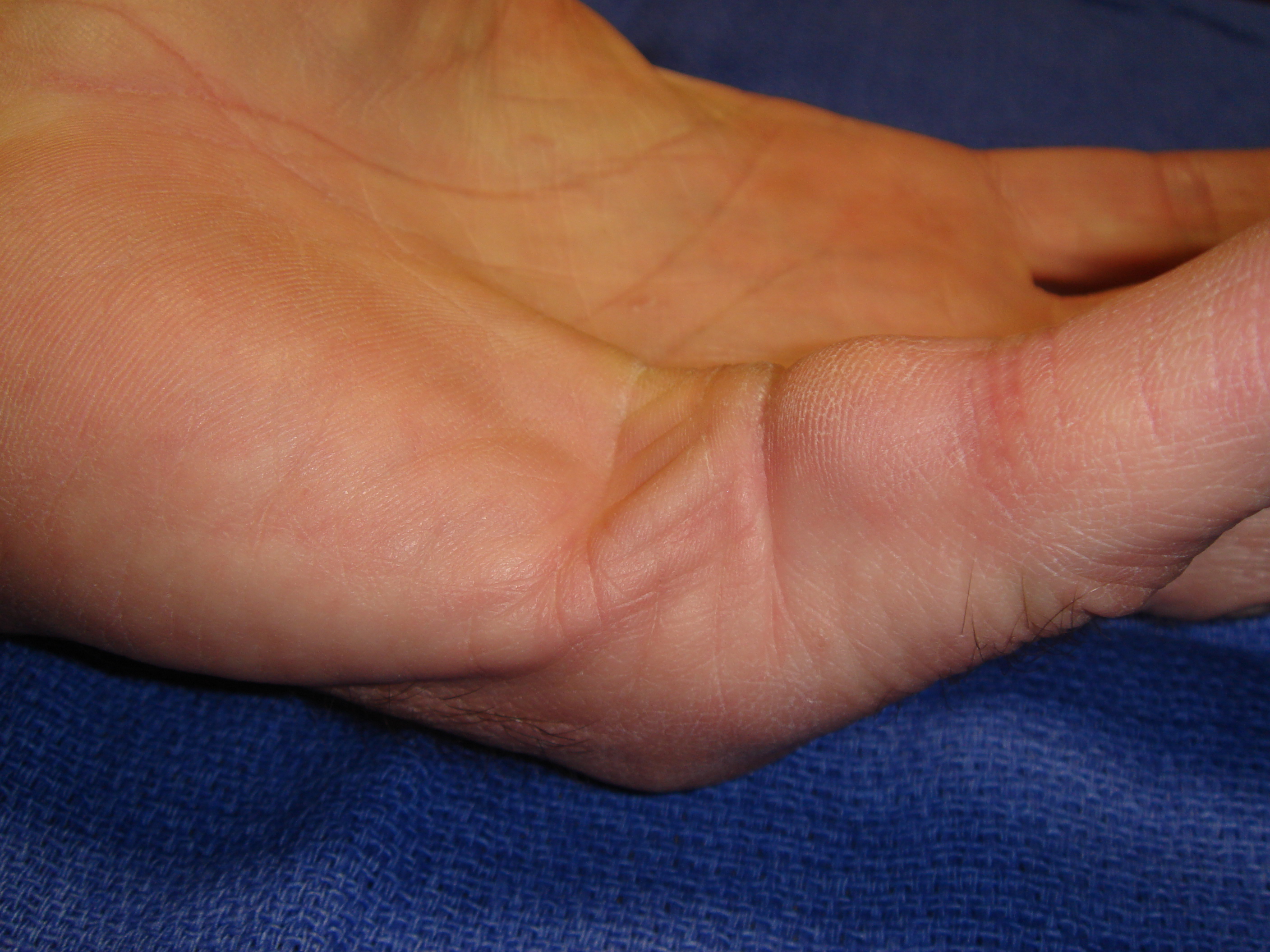 Figure 3b: This 46-year-old man has a strong family history of Dupuytren’s disease but without ectopic sites. There is contracture of the left fifth ray from a central cord.