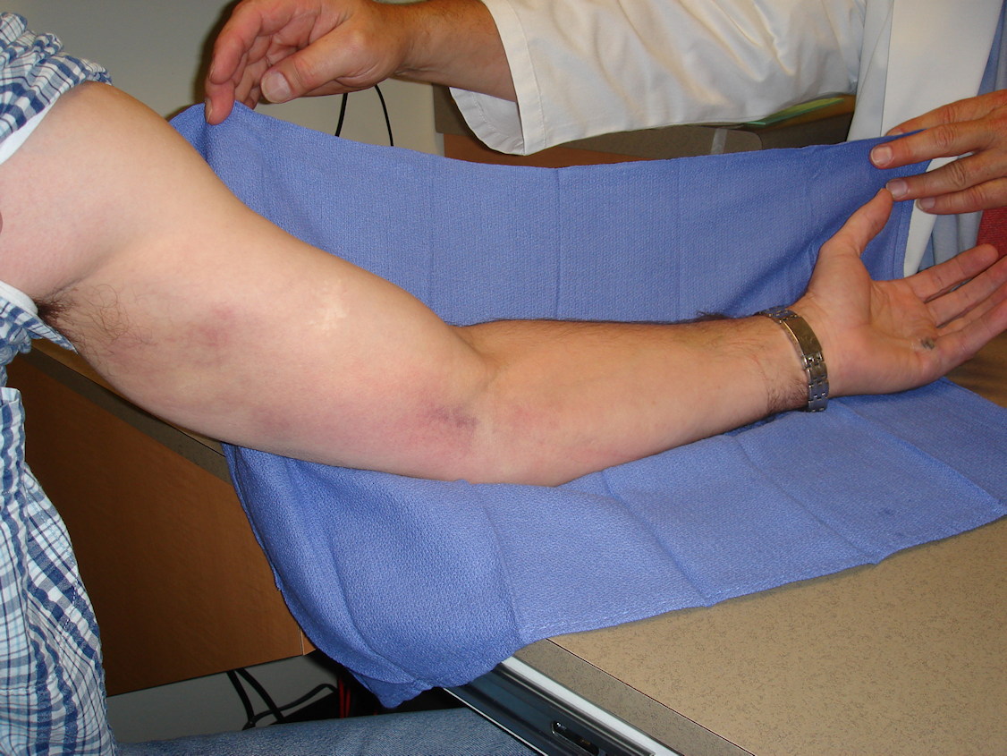 Figure 3c: At 48 hours after enzyme injection there is epitrochlear and axillary bruising with swelling and mild discomfort.
