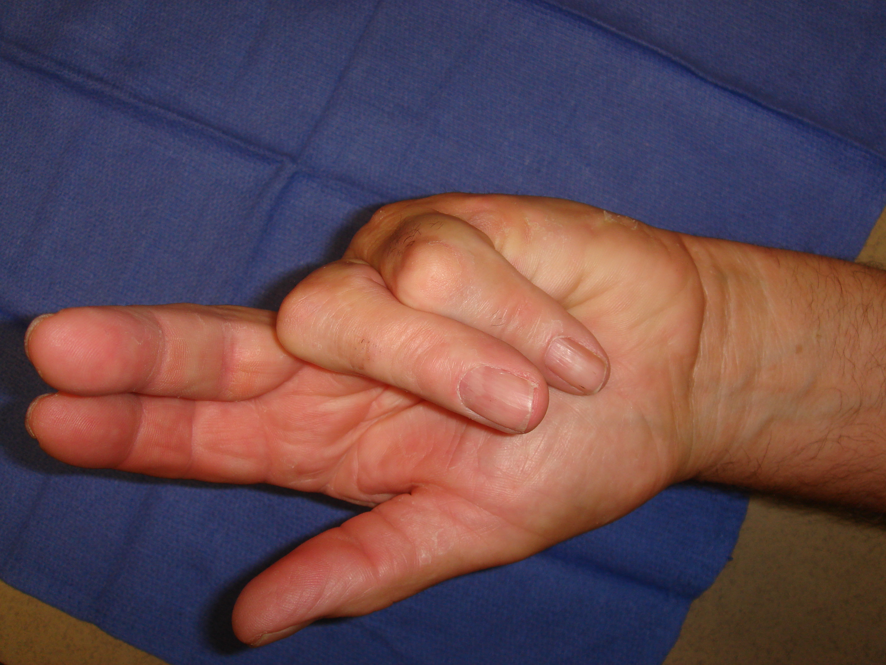 Figure 6b: This patient has advanced post-surgical recurrence of Dupuytren’s contracture affecting his left ring and little fingers. There is very limited active and passive ROM. The patient refused to have surgery again, despite dysfunction, but sought collagenase on the advice of a friend who was treated with CCH. Identifiable, palpable cords are present in addition to scar tissue; ultimately, more than 1 treatment cycle was going to be required; treatment started with the little finger.