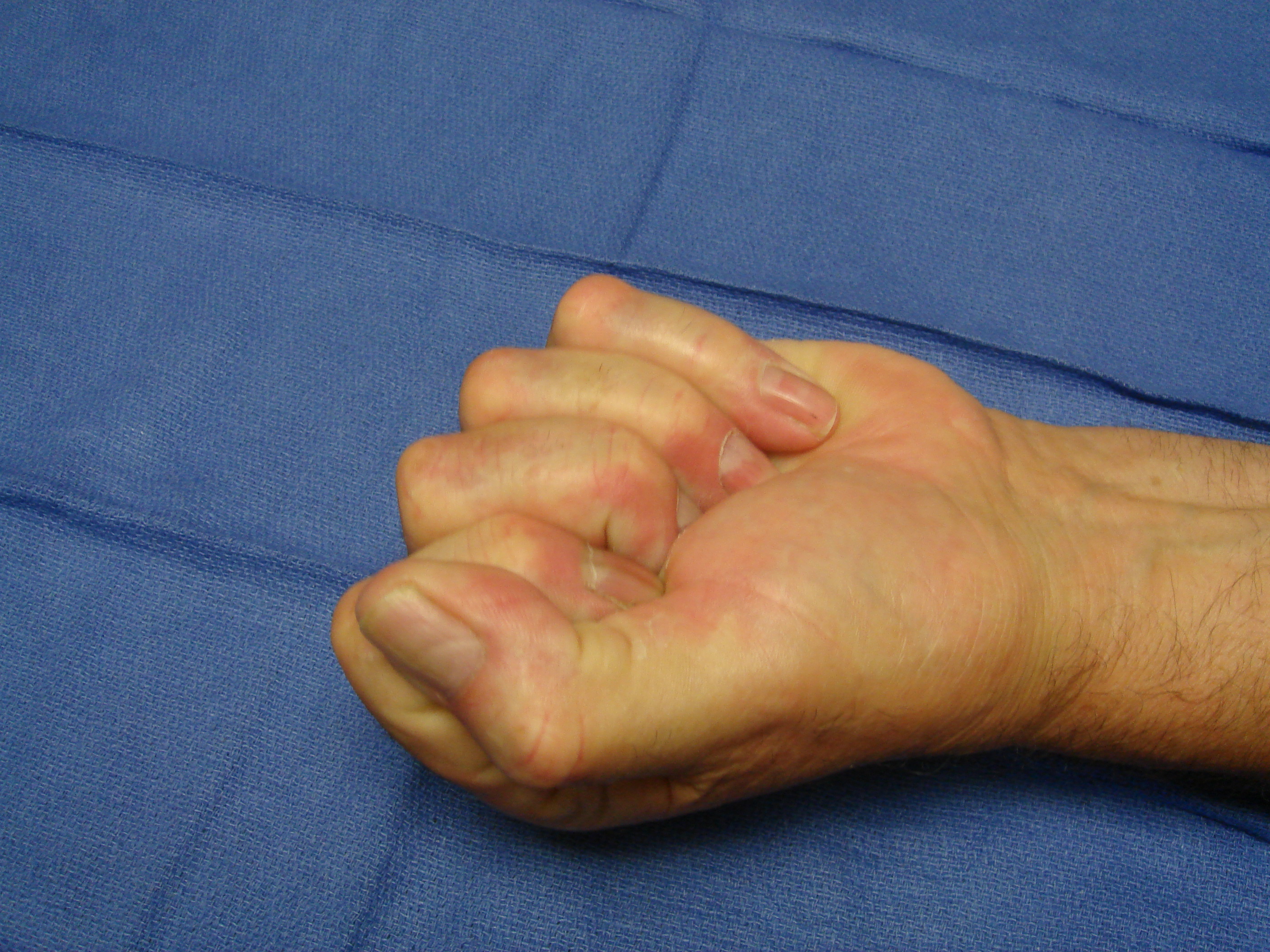 Figure 6c: This patient has advanced post-surgical recurrence of Dupuytren’s contracture affecting his left ring and little fingers. There is very limited active and passive ROM. The patient refused to have surgery again, despite dysfunction, but sought collagenase on the advice of a friend who was treated with CCH. Identifiable, palpable cords are present in addition to scar tissue; ultimately, more than 1 treatment cycle was going to be required; treatment started with the little finger.