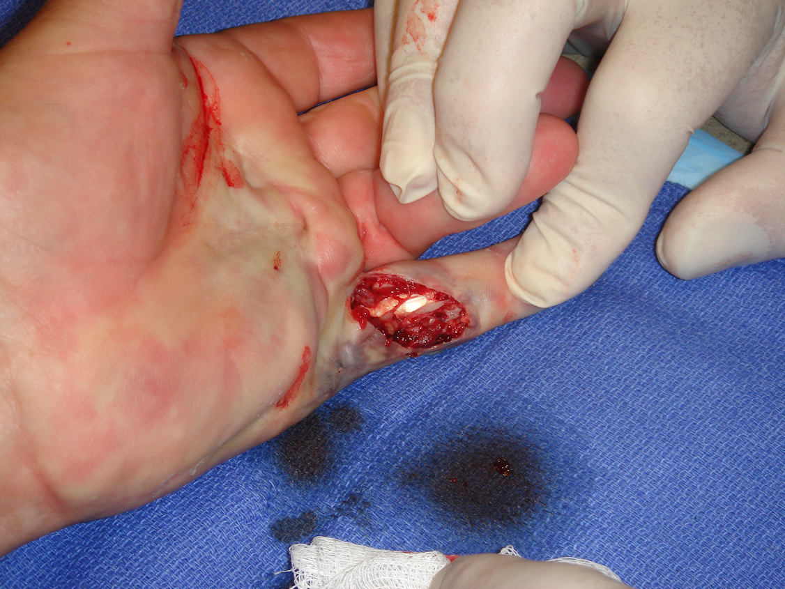 Figure 6d: Post-manipulation, he regained significant MP and PIP extension and had a skin tear over almost the entire proximal phalanx (due to the scarred, tethered skin), with flexor sheath exposed. Wound care was Silvadene® ointment, light gauze, and at least twice-daily washing and redressing during the next 3 weeks.