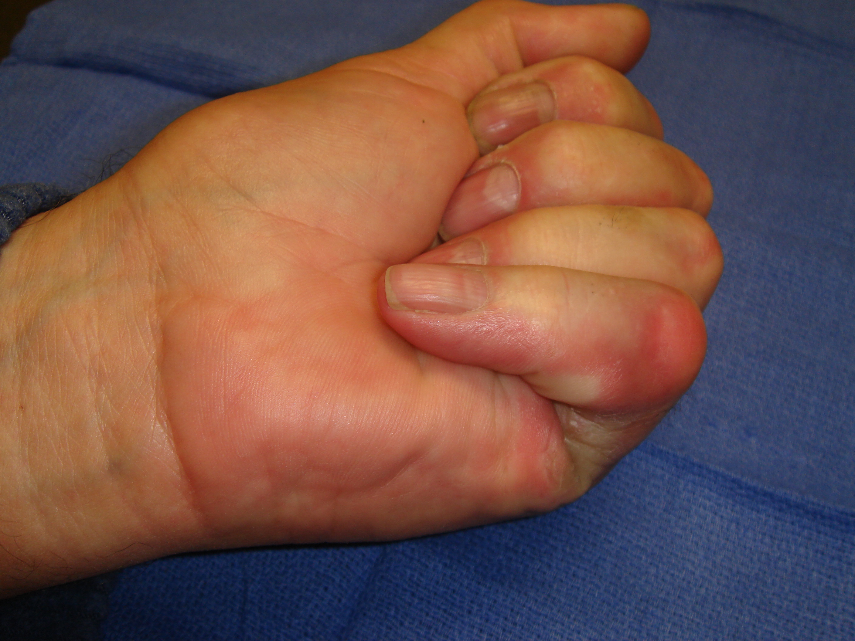 Figure 6g: Two months post-manipulation, the skin tear is healed. He has useful but incomplete MP and PIP motion after enzyme correction of the contractures. Limited little finger distal interphalangeal (DIP) joint flexion from osteoarthritis is evident with active grip.