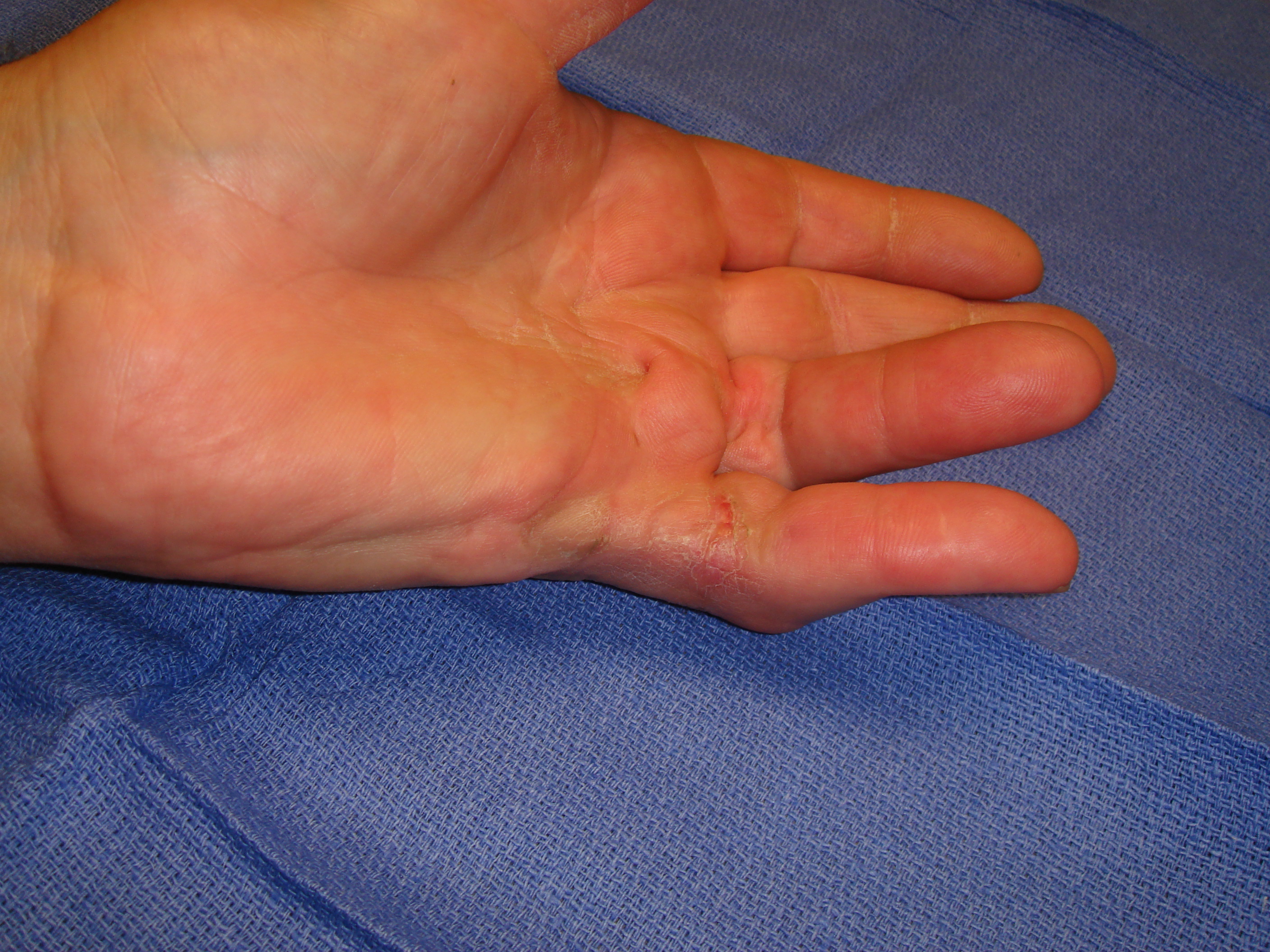 Figure 6h: Two months post-manipulation, the skin tear is healed. He has useful but incomplete MP and PIP motion after enzyme correction of the contractures. Limited little finger distal interphalangeal (DIP) joint flexion from osteoarthritis is evident with active grip.