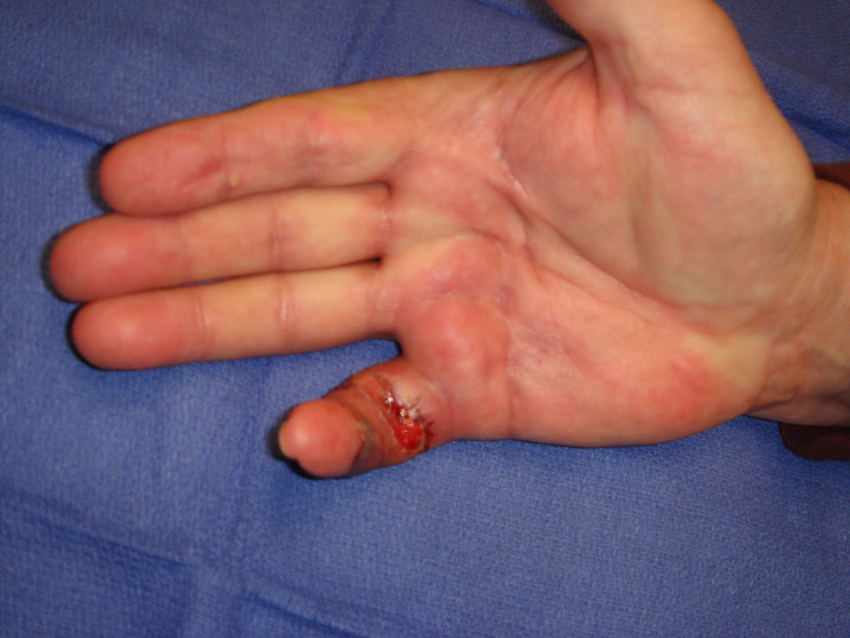 Figure 7e: Two weeks after little finger manipulation the proximal phalangeal/PIP skin tear is healing. He wore this static hand-based extension splint nightly during the next 3 months.