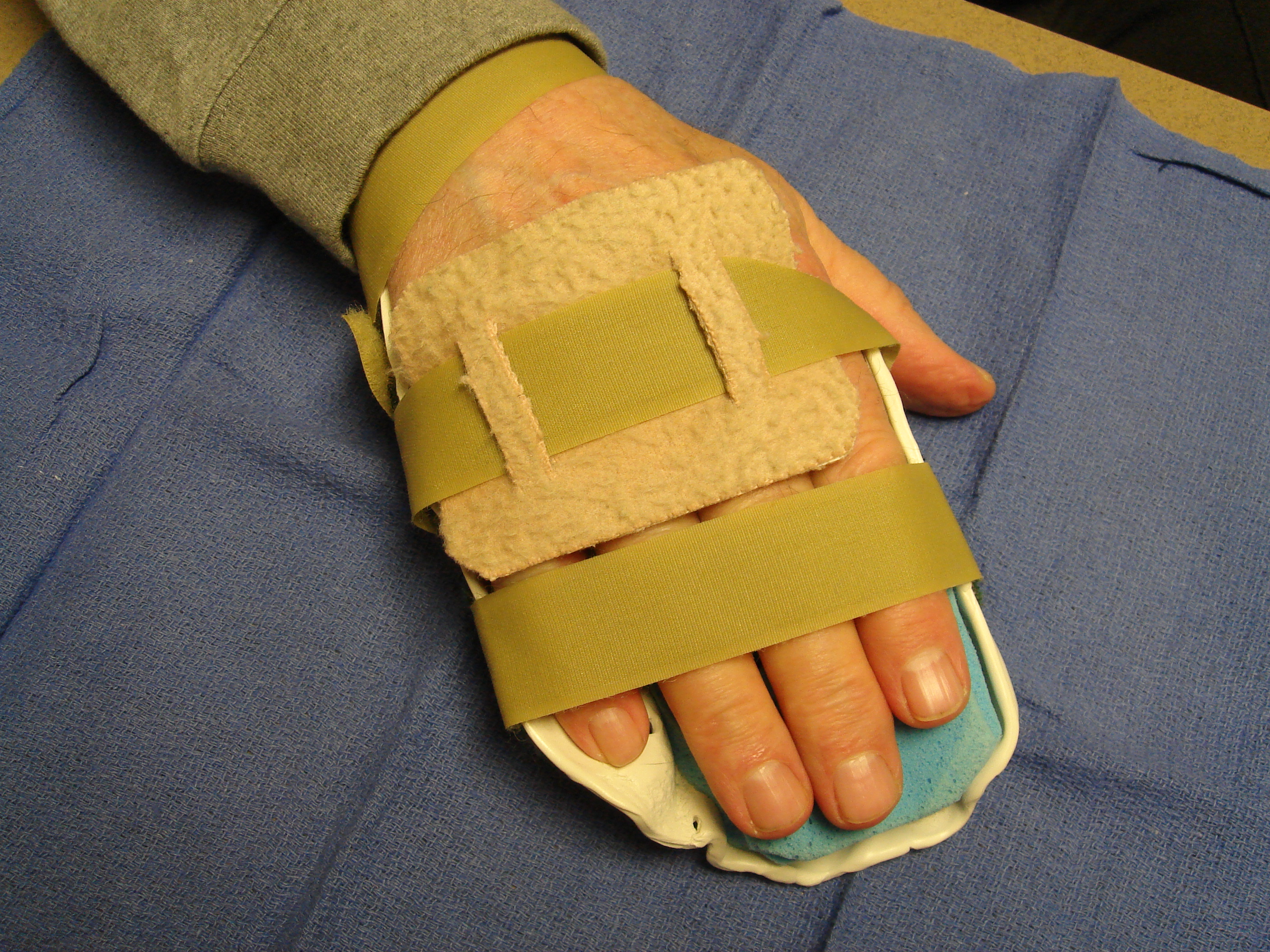 Figure 7f: Two weeks after little finger manipulation the proximal phalangeal/PIP skin tear is healing. He wore this static hand-based extension splint nightly during the next 3 months.