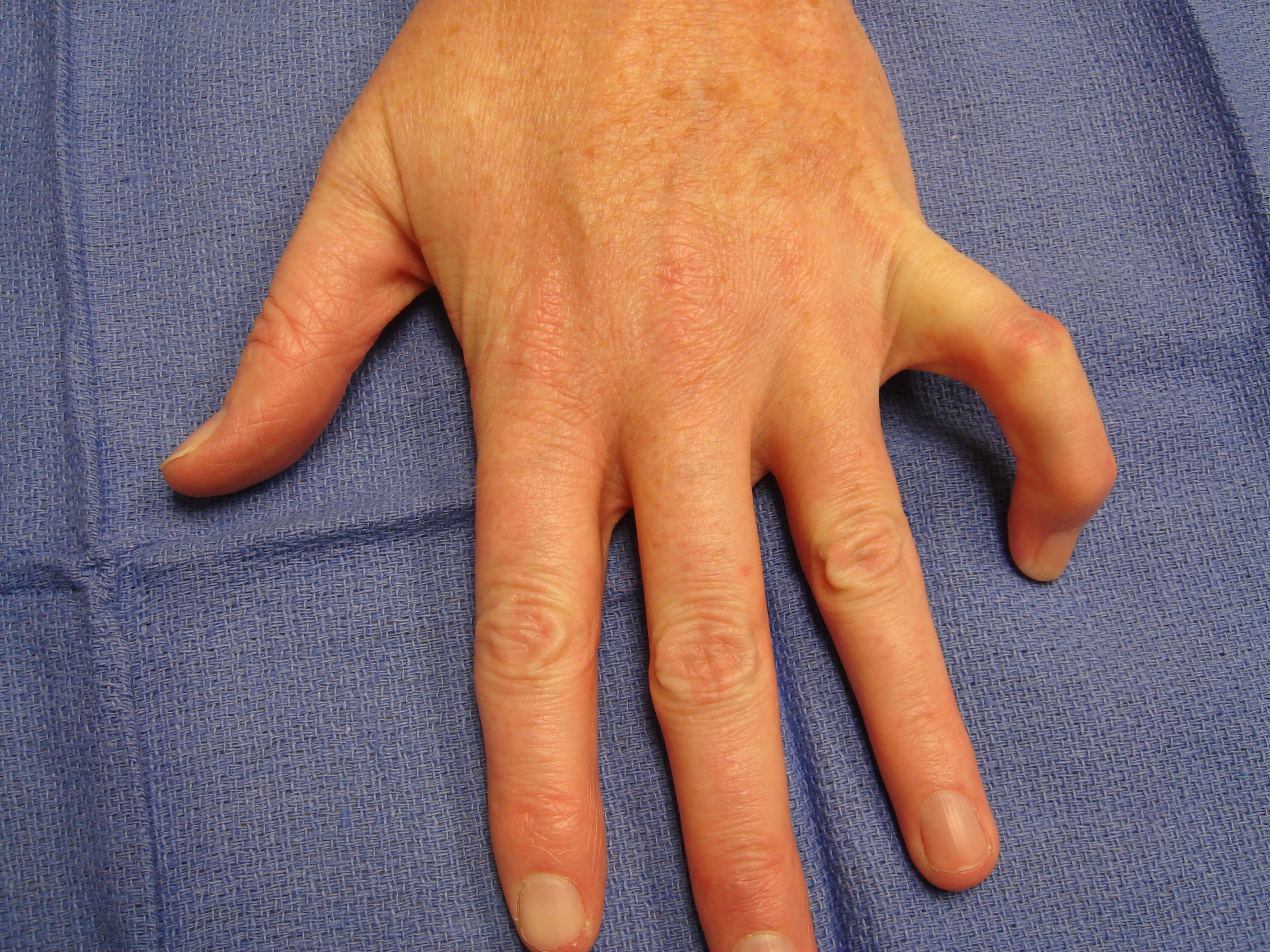 Figure 8a: These images show a woman in her mid-50s with a significant, little-finger, combined (contiguous cord) PIP and DIP contracture. The MP joint was not affected. The injection and manipulation videos depict custom adaptation of the “safe technique” for such an unusual cases.