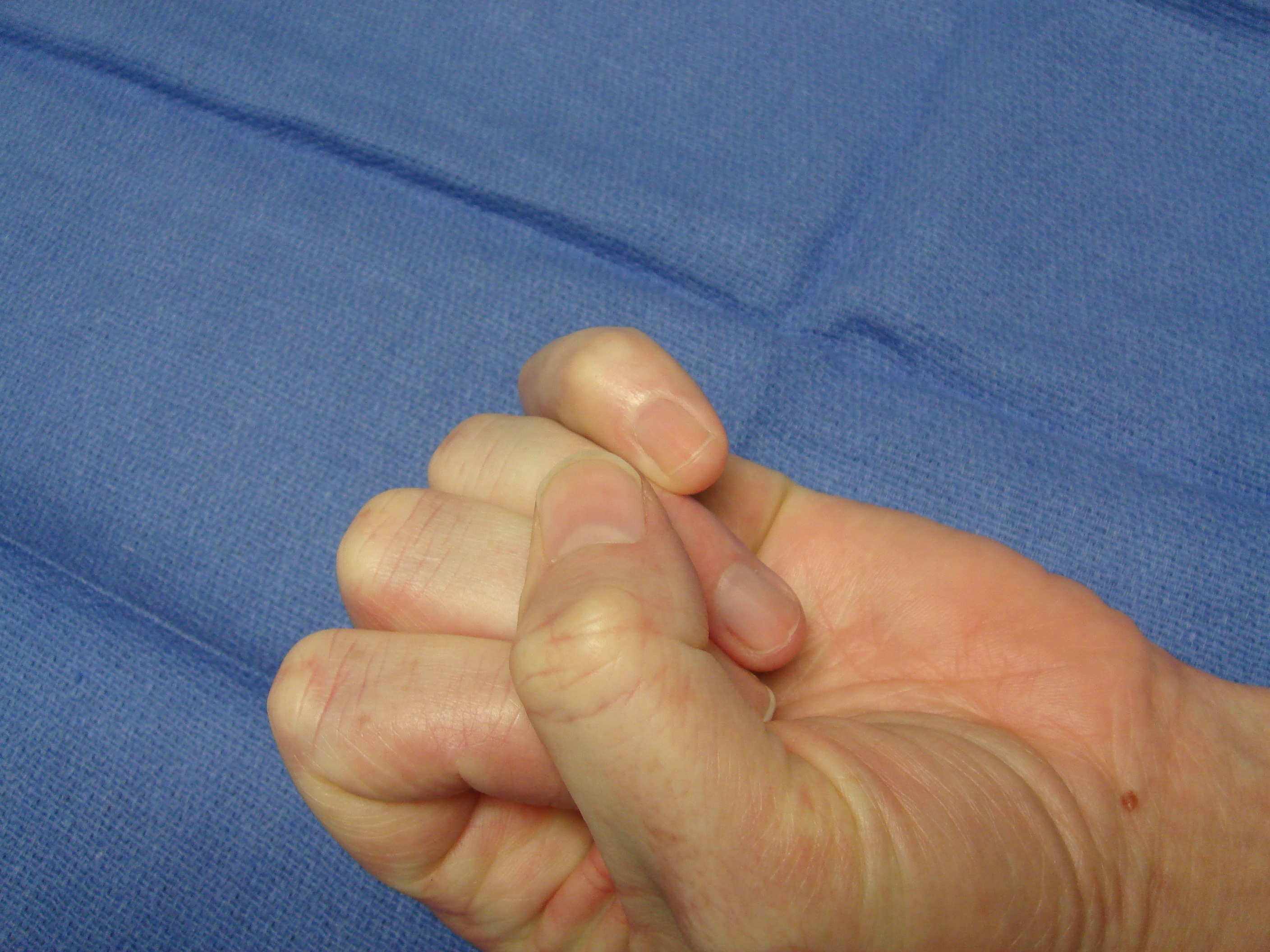Figure 8d: Post-manipulation, fingers with interphalangeal contractures (and some others) are sometimes transiently but notably vasospastic, but this will resolve within minutes.