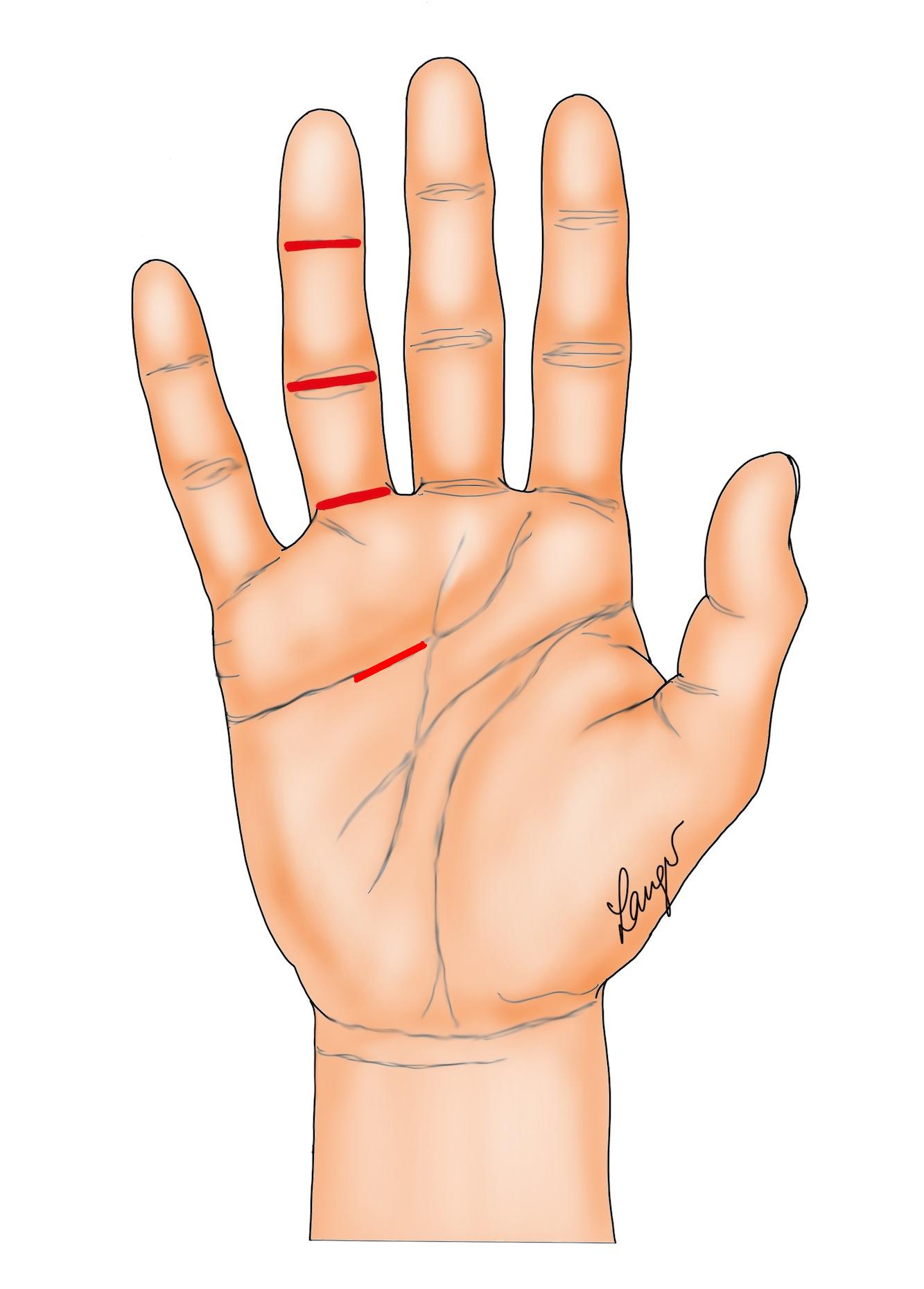 Figure 1: The incisions for segmental fasciectomy