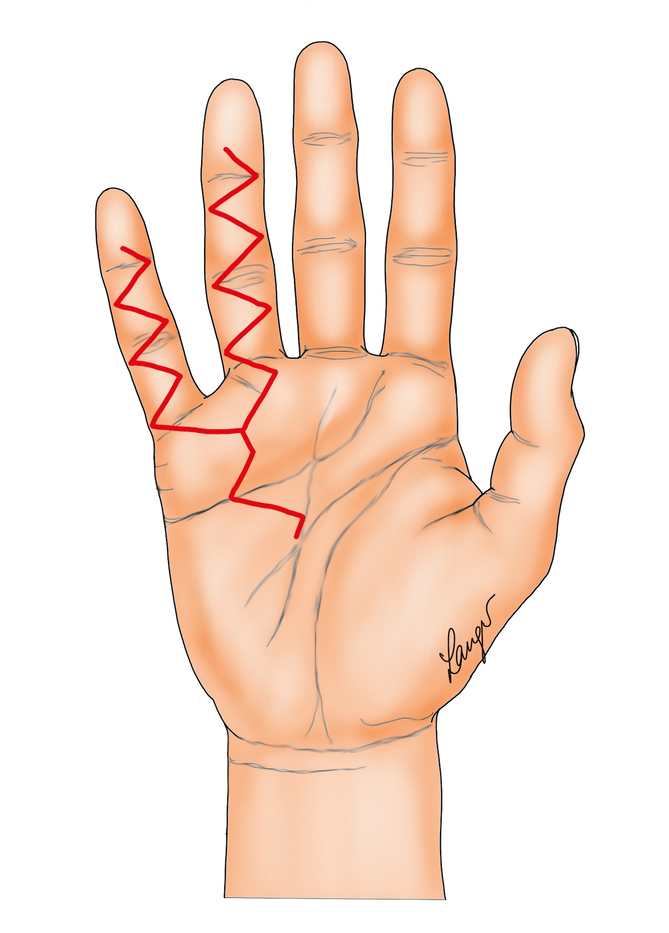 Figure 3: Variation on formal Bruner incisions