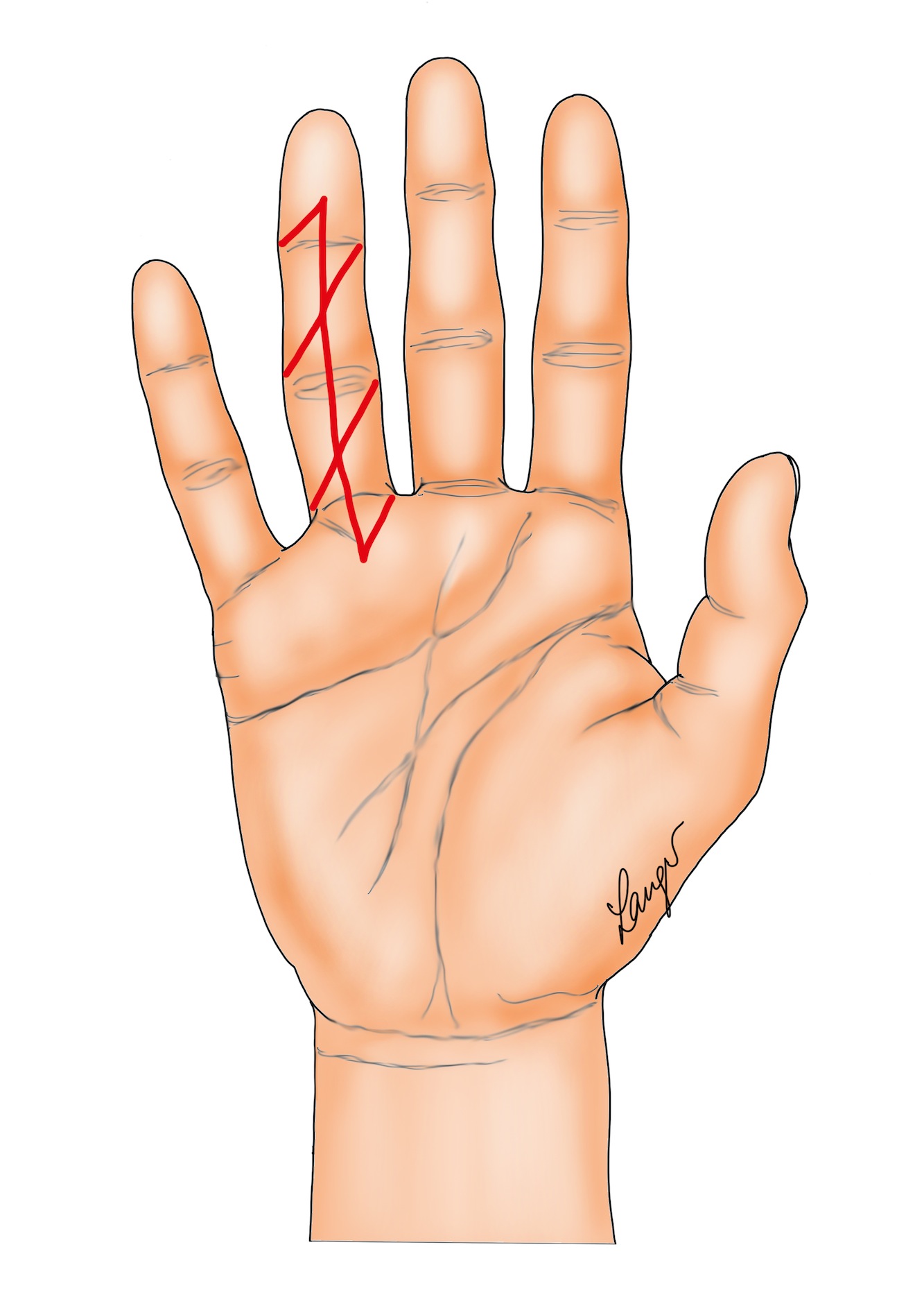 Figure 6a: Straight longitudinal incision closed with Z-plasties