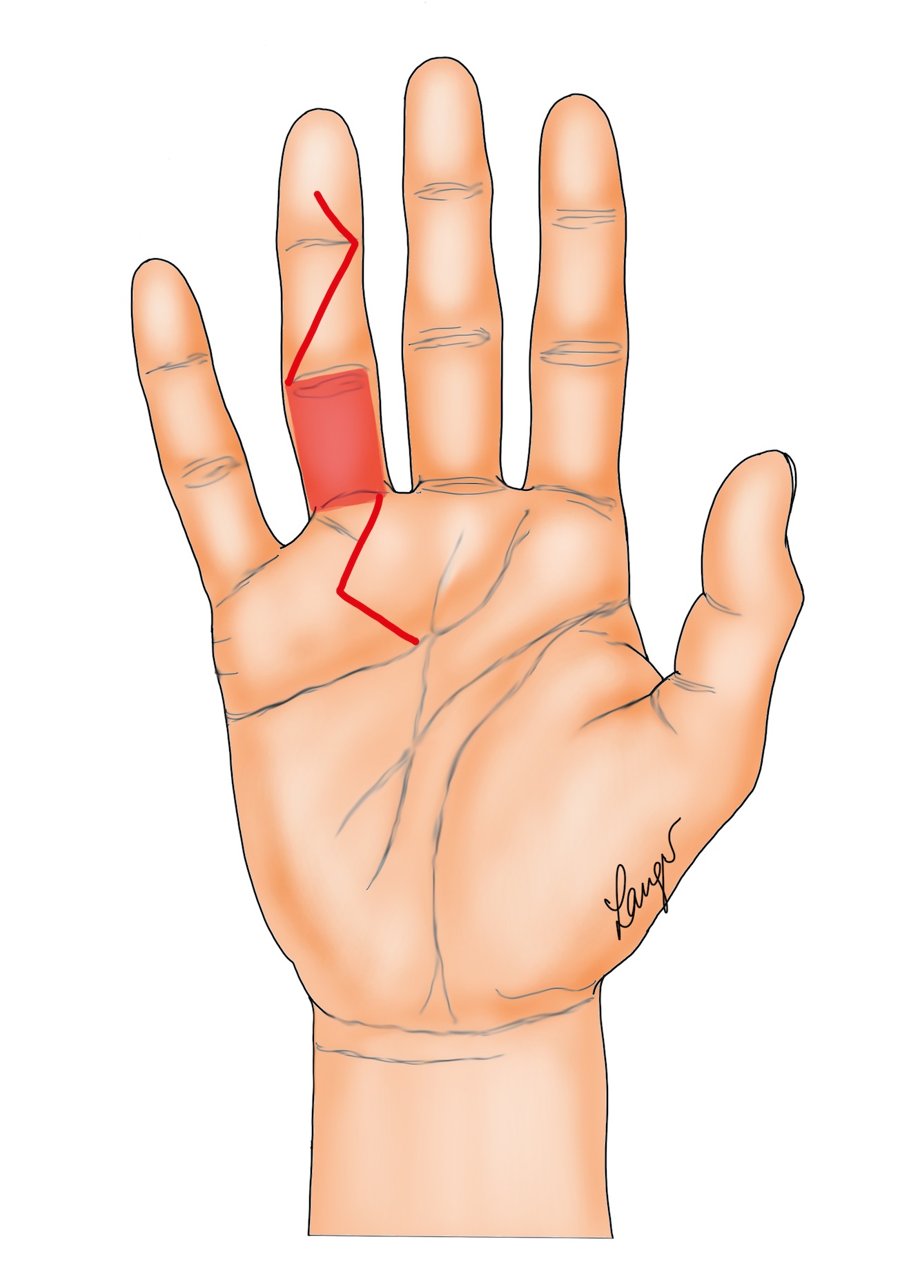 Figure 8a: An example of how to do a dermofasciectomy