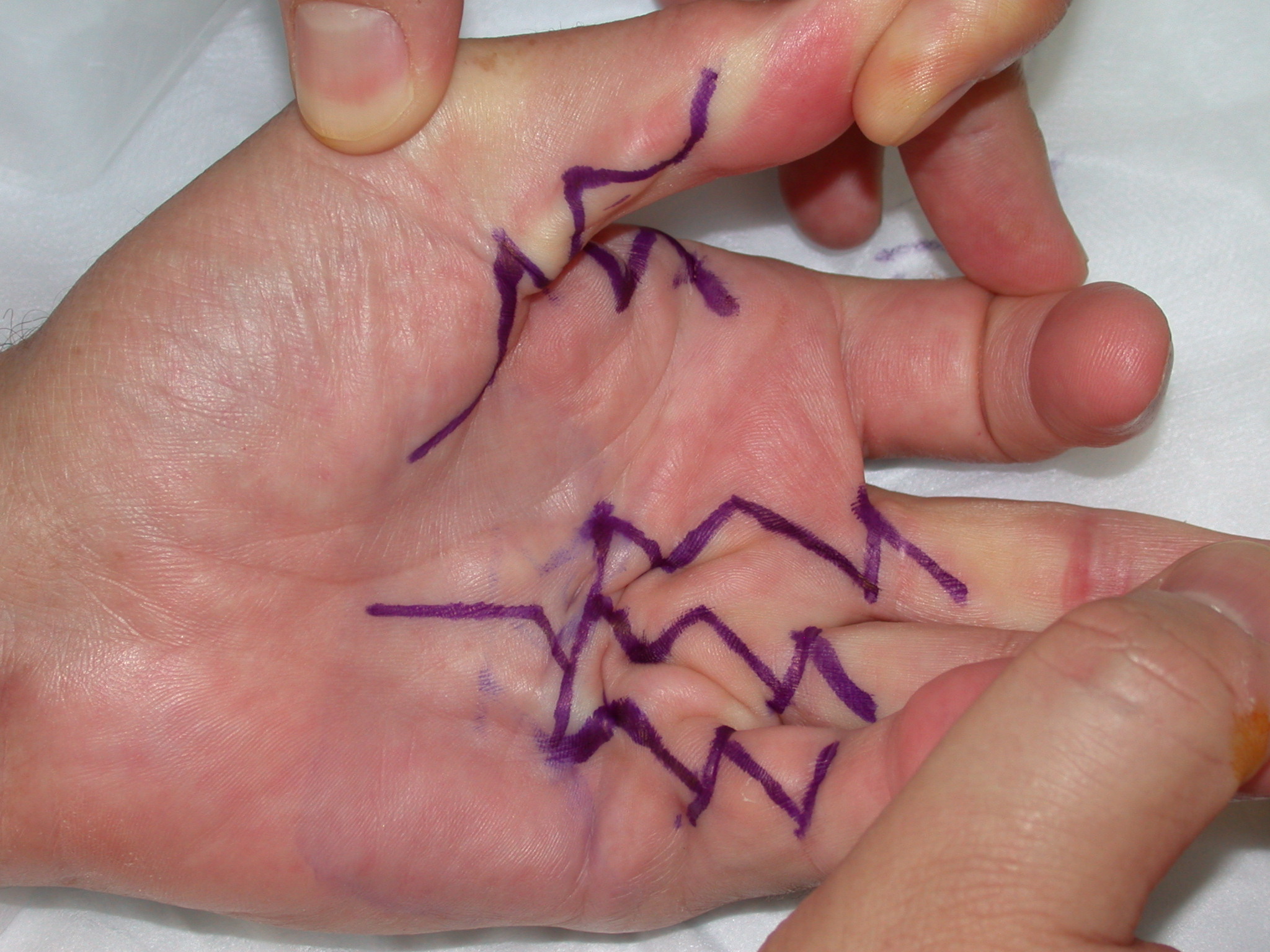 Figure 9a: Multiple digit surgery using the ÿãmodified Brunerÿâ approach.