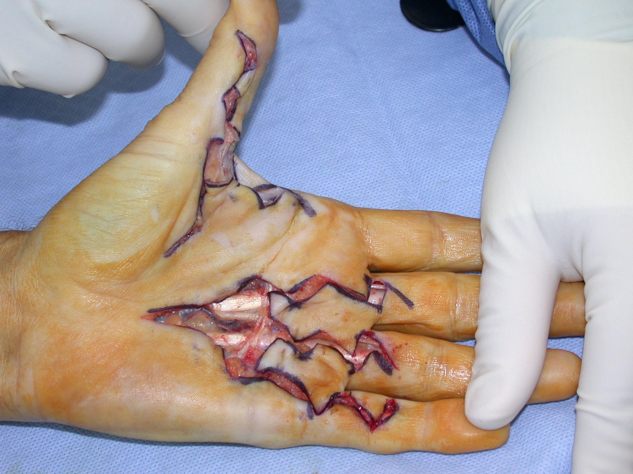 Figure 9b: Multiple digit surgery using the ÿãmodified Brunerÿâ approach.