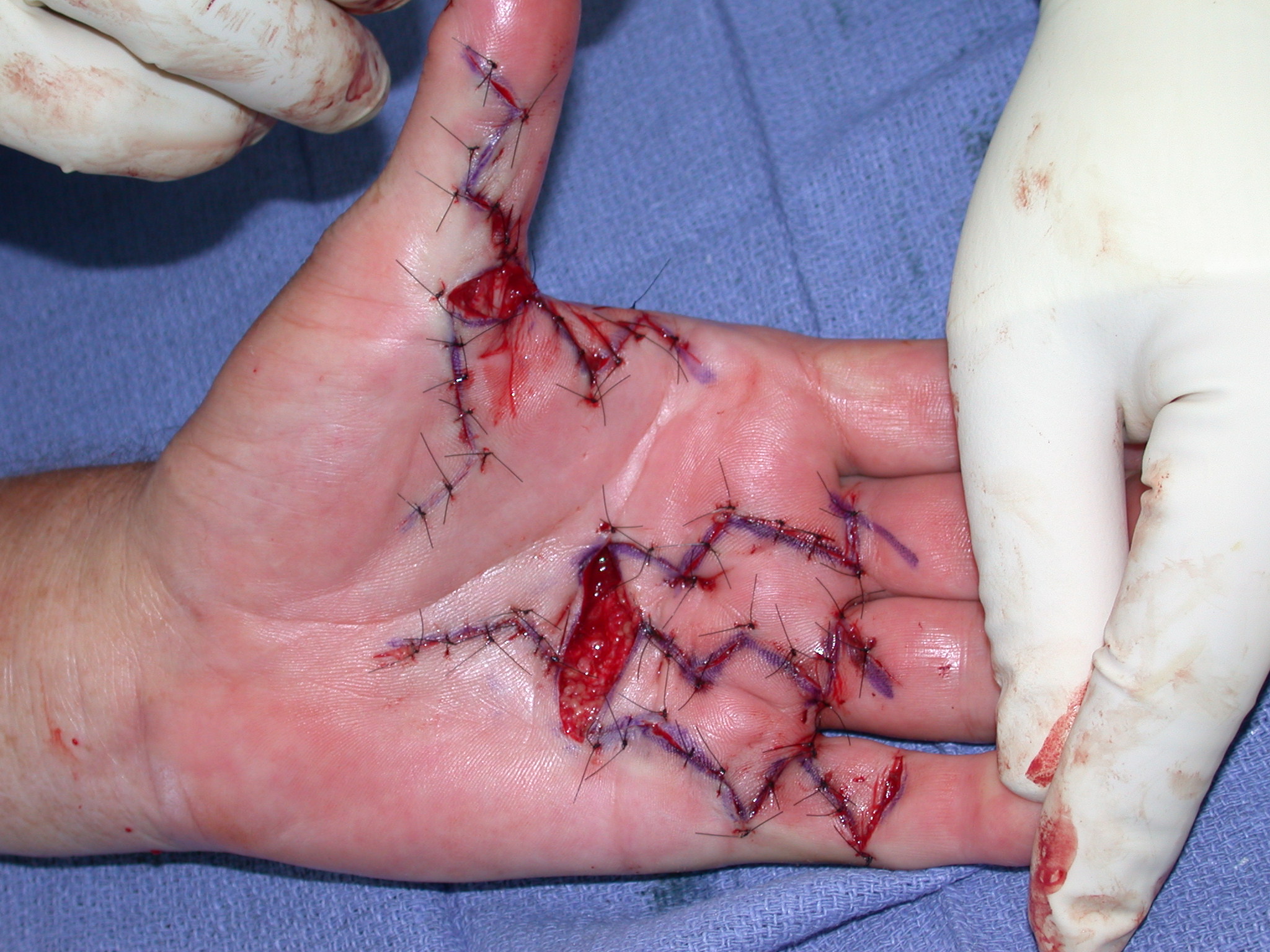 Figure 9c: Multiple digit surgery using the ÿãmodified Brunerÿâ approach.