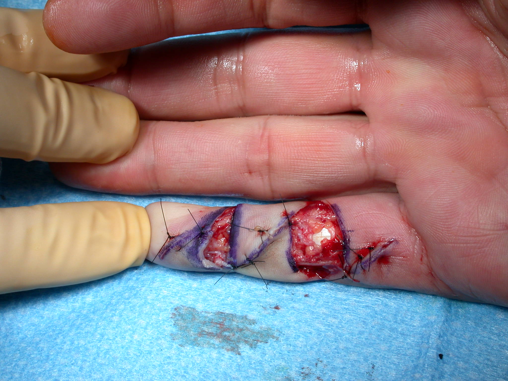 Figure 13a: The ÿãmodified Brunerÿâ incision with the transverse wounds left open. Note that a small area of exposed flexor tendon heals very well with dressings