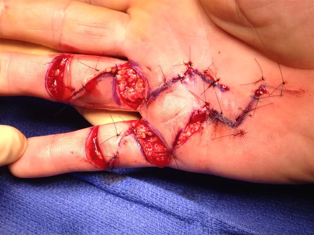 Figures 13b: The ÿãmodified Brunerÿâ incision with the transverse wounds left open. Note that a small area of exposed flexor tendon (as seen in 13a) heals very well with dressings