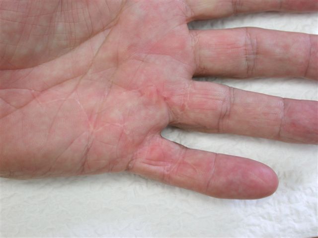 Figures 14b: Patients treated with the open wound technique showing fine scars at follow-up