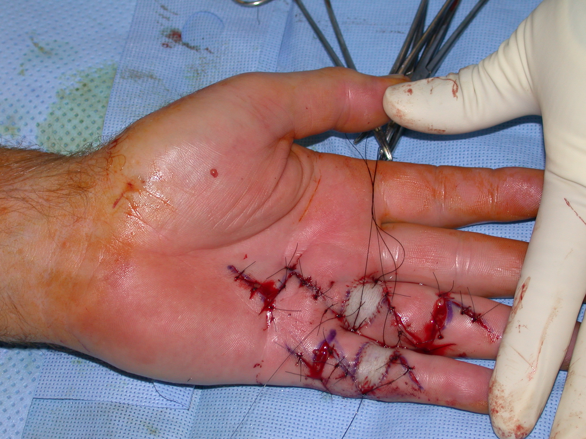 Figure 15: The ÿãmodified Brunerÿâ incision with FTSGs