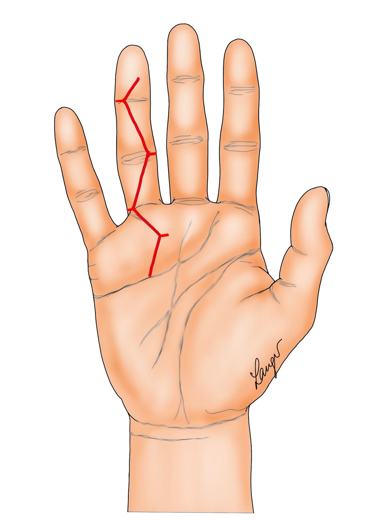 Figure 4: Multiple Y-V flaps based on ÿçlazyÿæ Bruner incisions