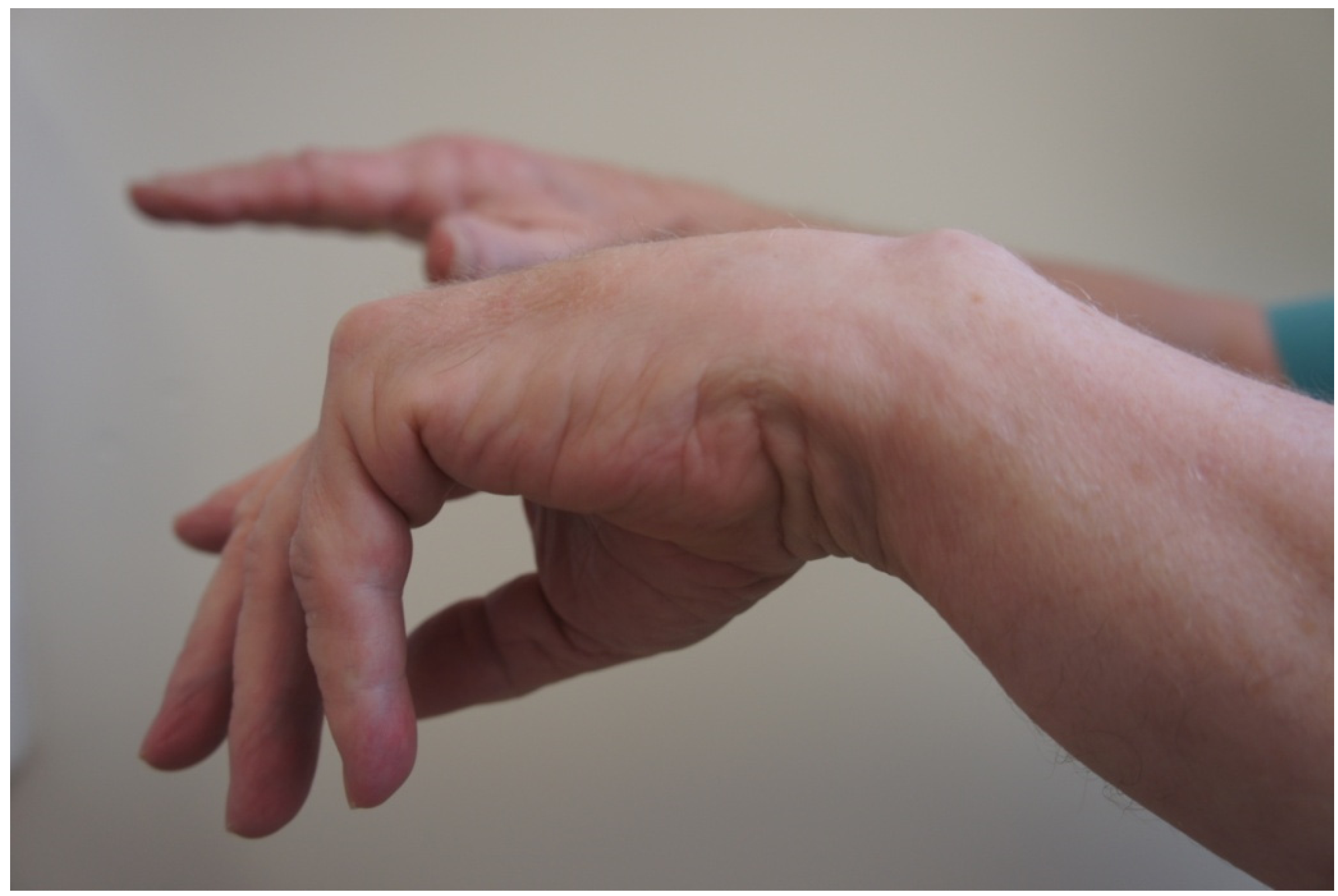 Figure 2: Posterior interosseous syndrome in a male patient with inability to fully extend the fingers or thumb of the right hand. Note radial deviation of wrist.