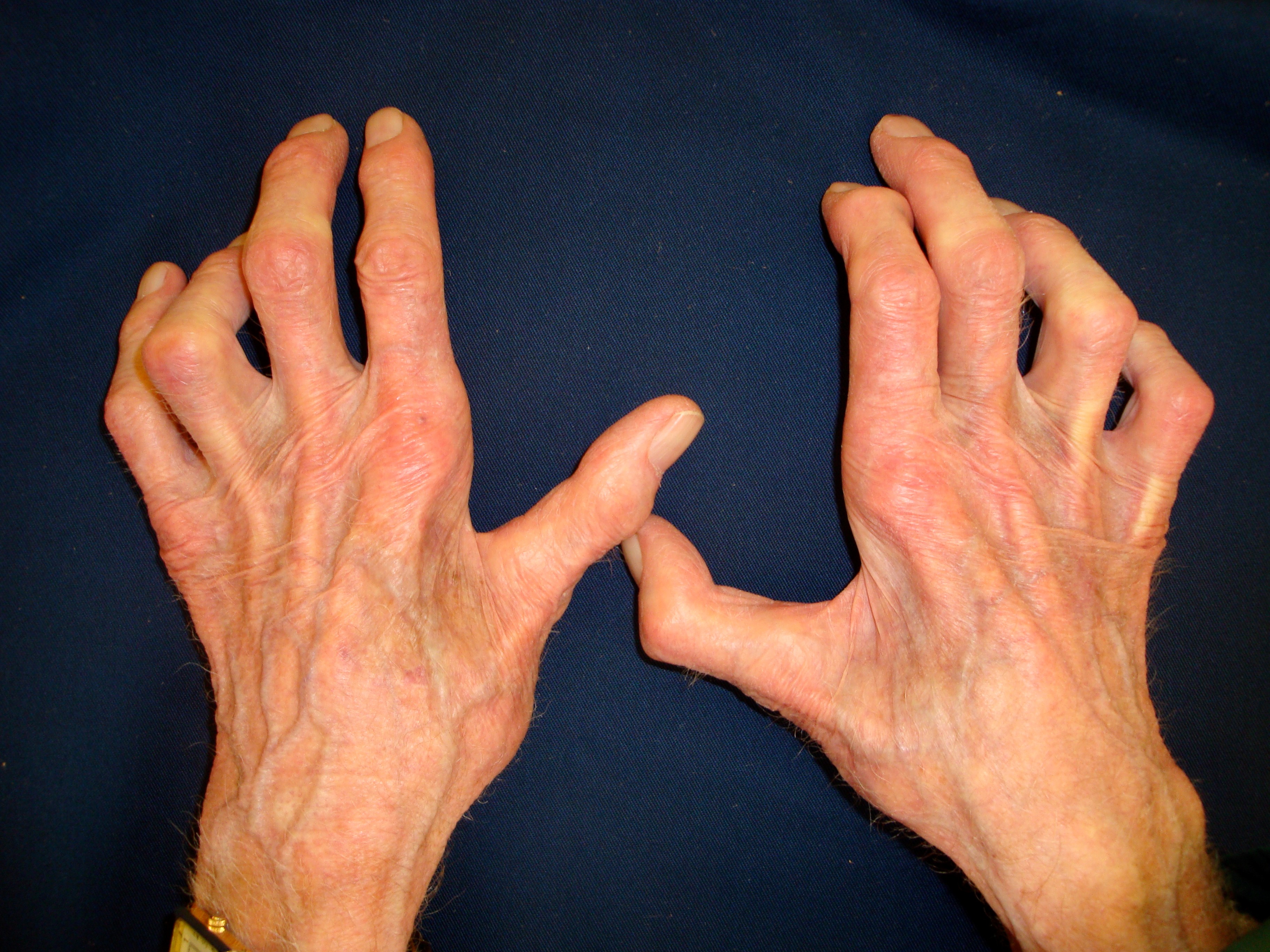 Figure 3b: Low ulnar nerve lesion with marked clawing
