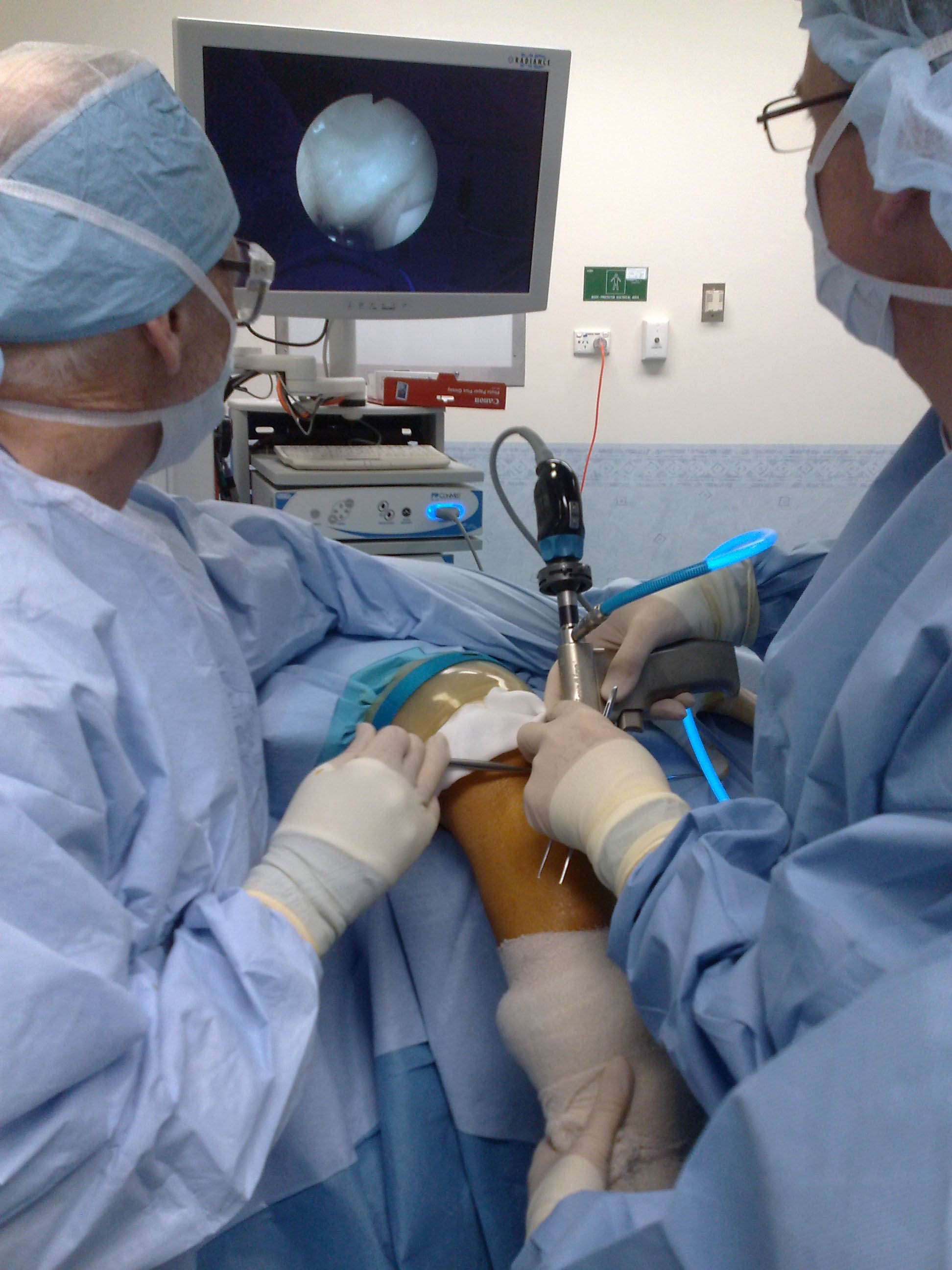 Figure 5: Endoscopic cubital tunnel decompression using the Microaire “Agee” device