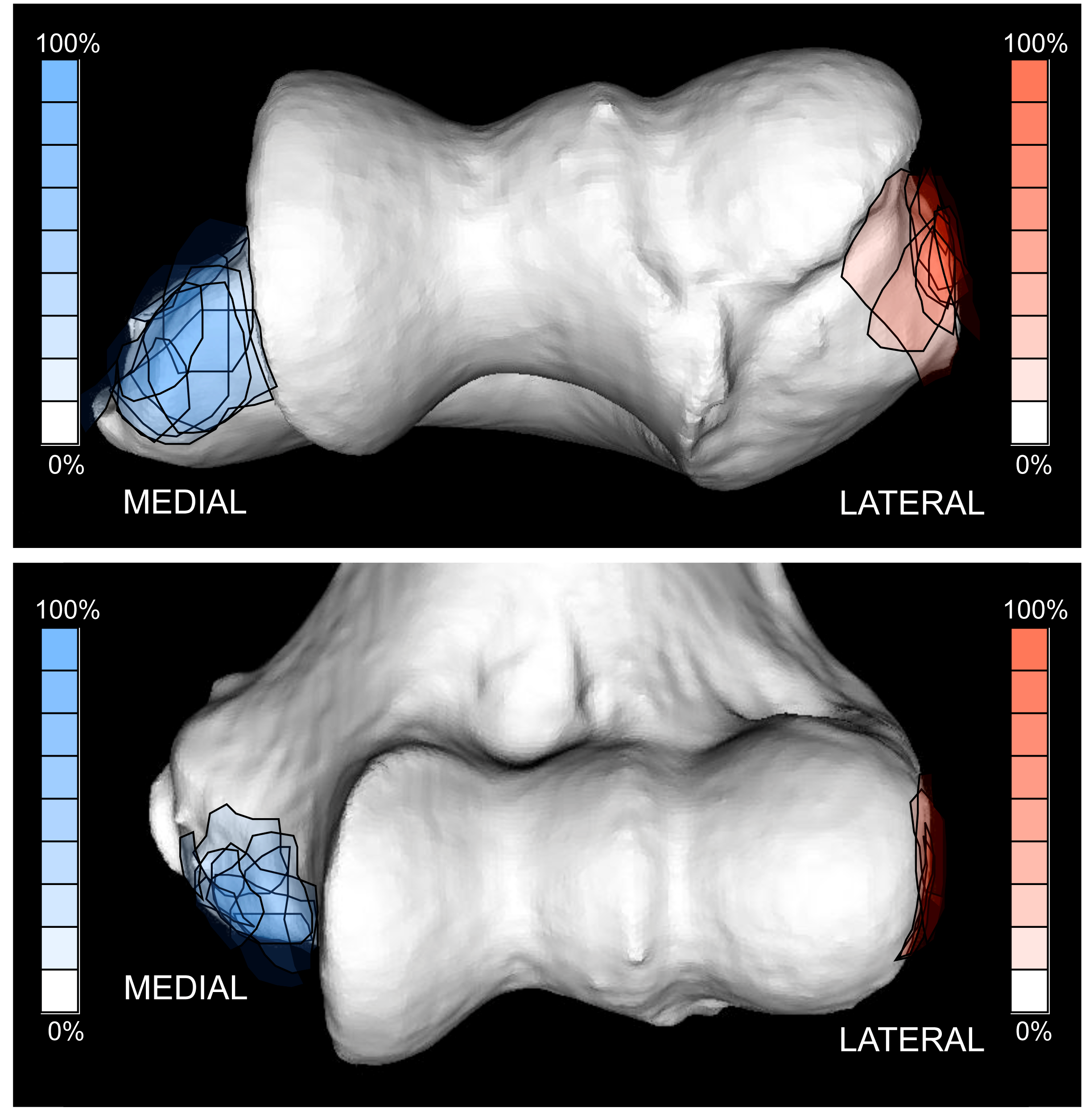 Figure 7: Origin of the medial (blue) and lateral ligaments (red) of the elbow from cadaveric dissection. Note the position of the origin of the medial ligament on the medial epicondyle that is at risk of disruption in medial epicondylectomy.