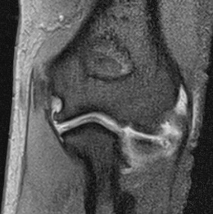 Figure 8: MRI of the elbow following medial epicondylectomy. Note disruption of medial collateral ligament.