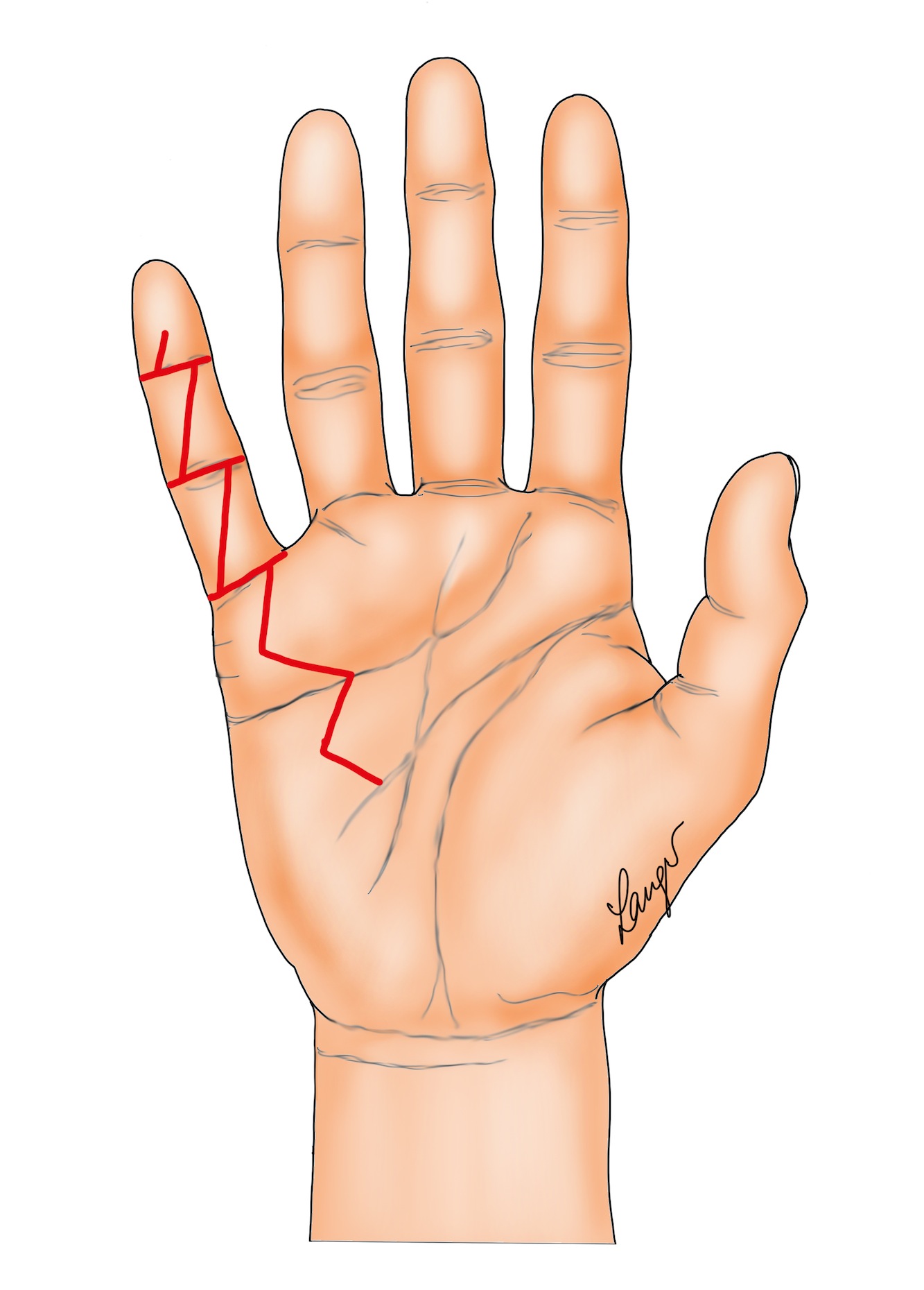 Figure 7: The "modified Bruner" incision used by the author