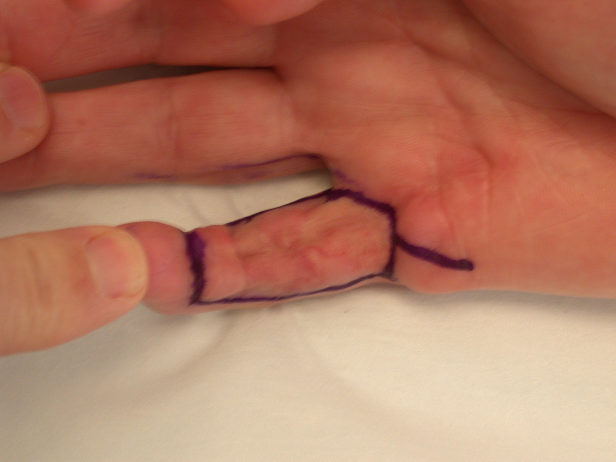 Figure 8b: Patient with three times recurrent disease treated by dermofasciectomy shown with incisions marked pre-operatively and at follow-up after FTSG