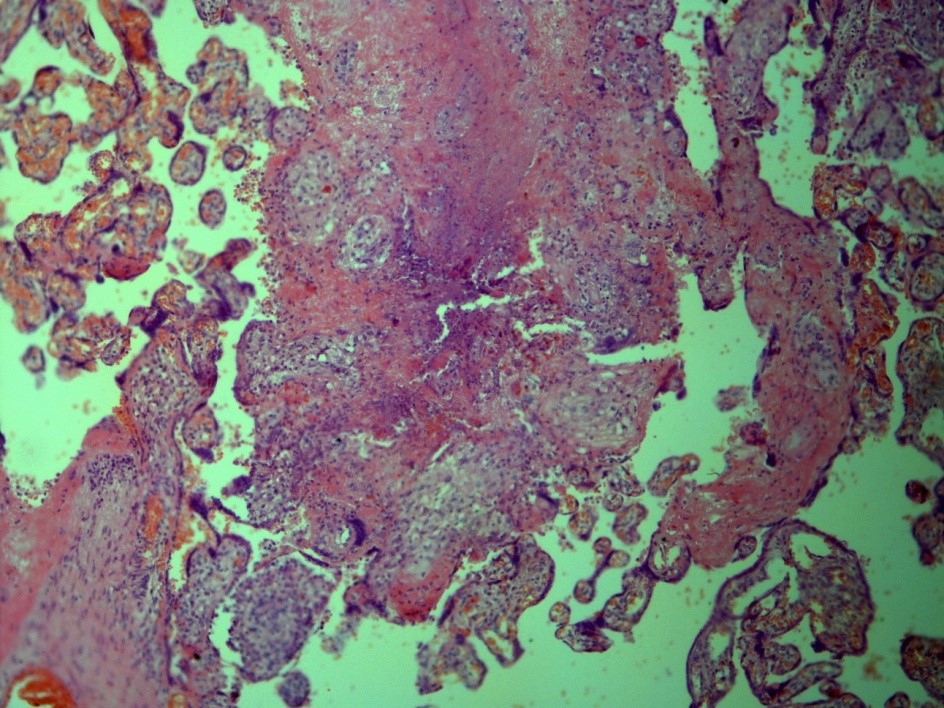 Figure 1: TB of placenta. Caseous inflammation, typical for TB.