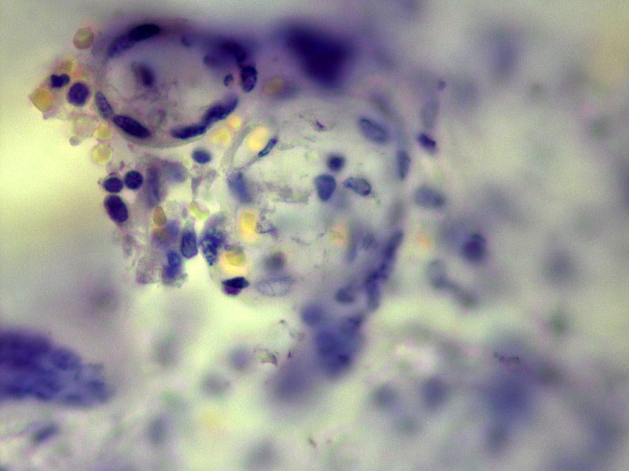 Figure 2: Tissue of placenta, colored by Ziehl-Neelsen stain: Mtb are shown by arrow.