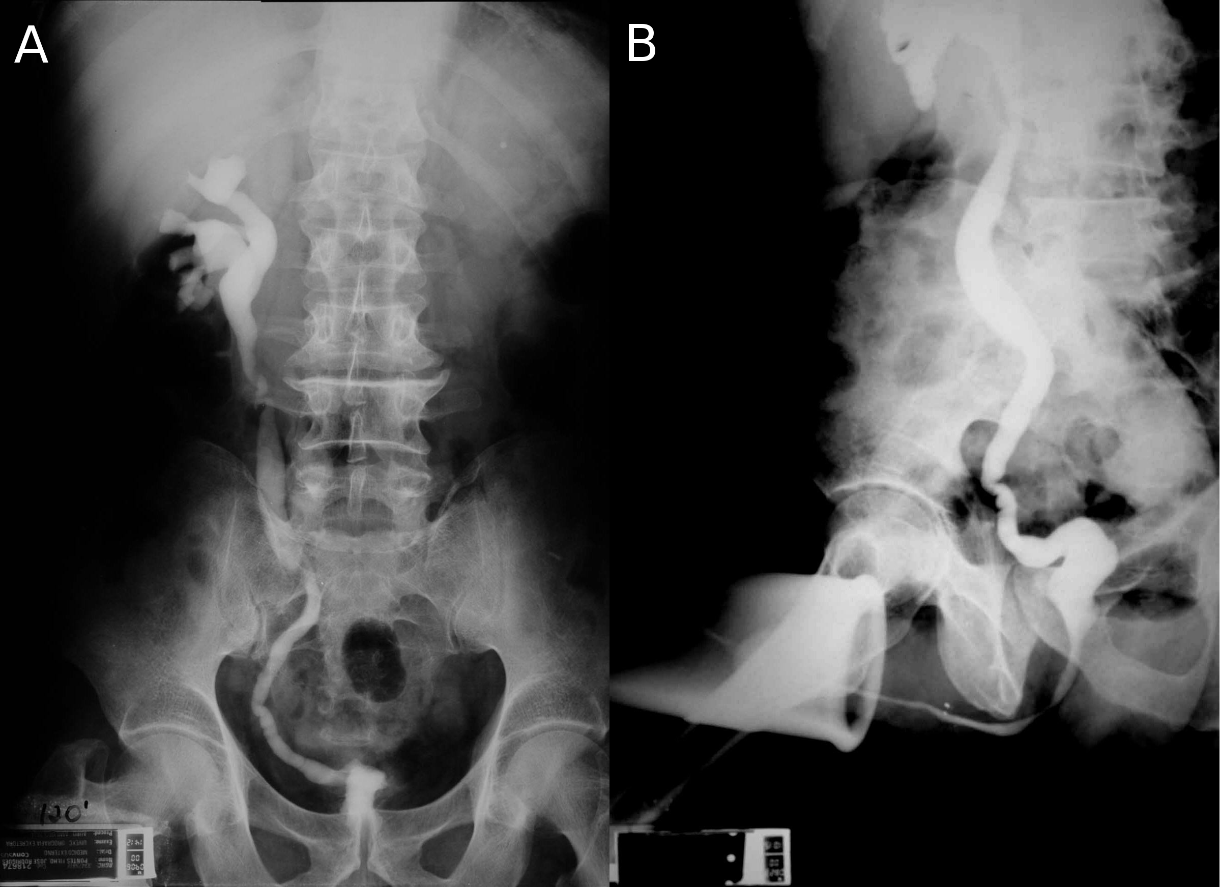 Figure 1: A: Intravenous urography with left non-function kidney, right uretero-hydronephosis and a very small contracted bladder. B: Voiding cystography shows contracted bladder and right vesico-ureteral reflux