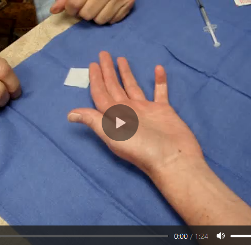 This shows injection technique for rare inter-phalangeal cords in this little finger