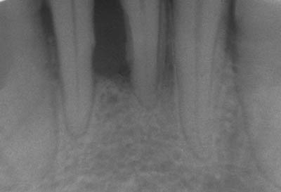 Abbildung 7: Paradontose (Zahn 31,41) von Bernard bill5 (Die Abbildung ist von der CC-BY 4.0-Lizenzierung ausgenommen: Lizenz CC BY-SA 3.0)
