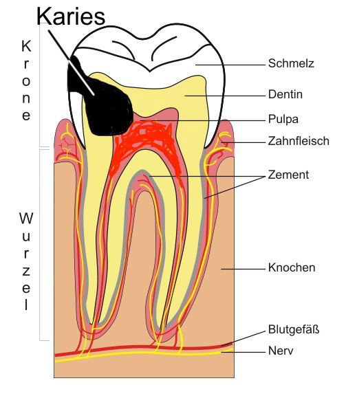 Abbildung 9: Zahnquerschnitt mit kariösem Defekt (CC BY-SA 4.0)