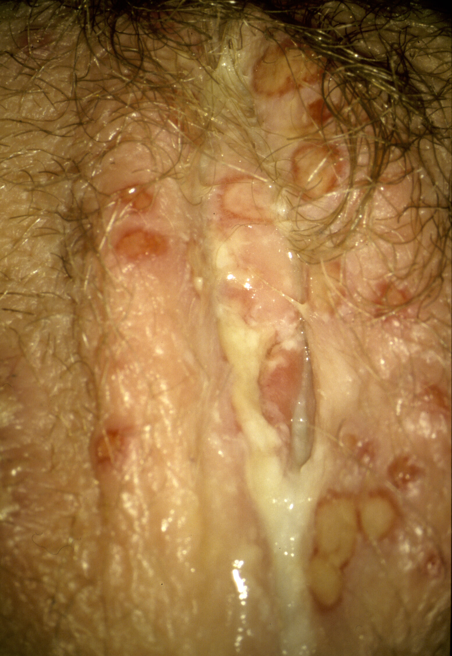 Vaginalis herpes Herpes Genitalis: