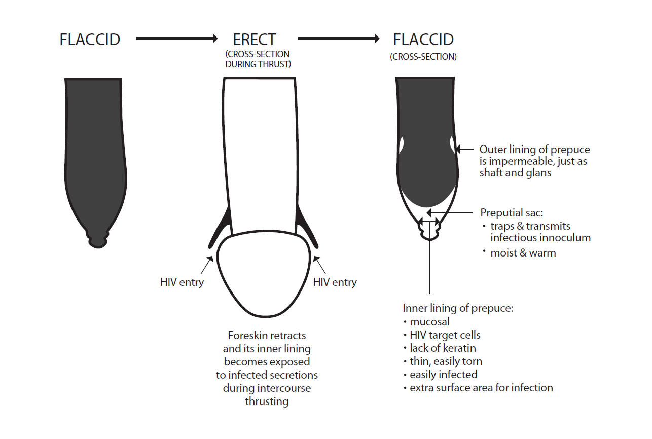Figure 1: Foreskin-associated factors that have been proposed to explain the higher HIV infection observed in uncircumcised men. The diagram of an uncircumcised penis in the erect state (center) depicts a typical appearance of the foreskin during thrusting. It should be noted, however, that the length of the foreskin of different men varies across a wide range from very short to very long. Thus the extent to which the glans is bared during intercourse varies greatly between different uncircumcised individuals. The foreskin is pulled forward during the outward motion and backwards during the forward motion involved in the thrusting that takes place during intercourse. When inserted into the vagina of an infected woman the vulnerable inner lining becomes exposed to the infectious inoculum. Thrusting exacerbates exposure of the inner lining.