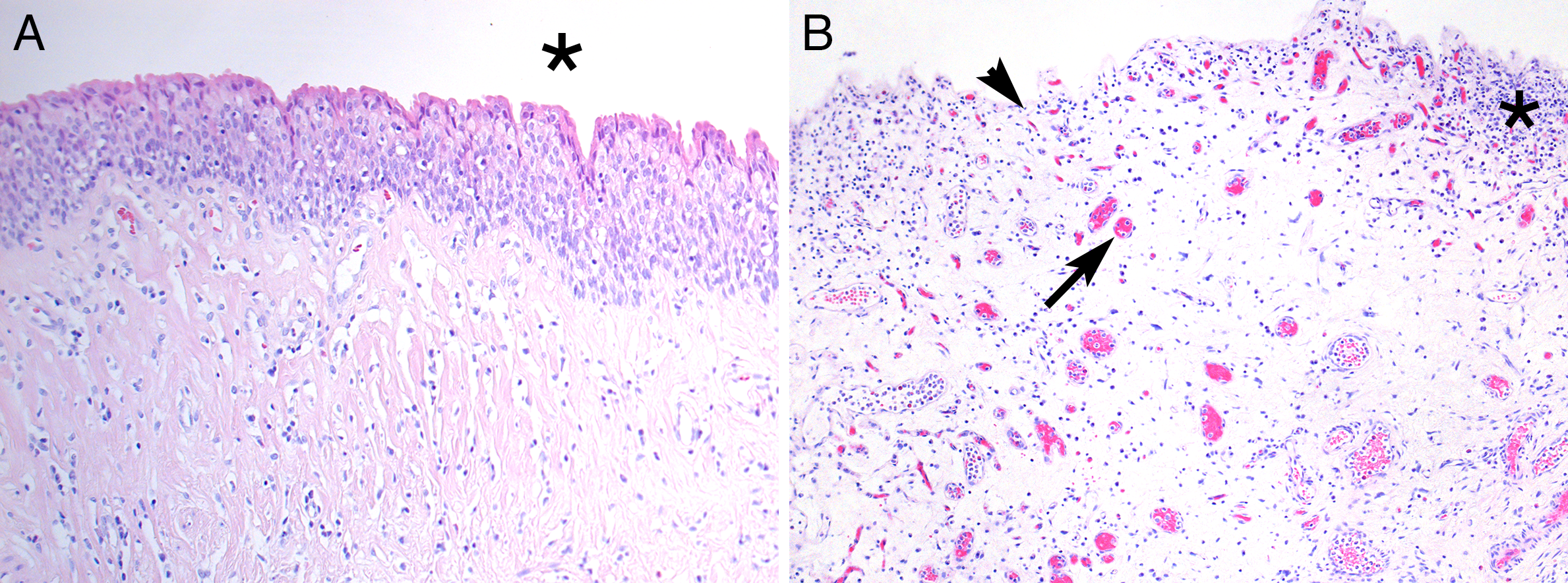 Figure 2a: Normal Bladder showing intact urothelium with umbrella cells (star). Figure 2b: Abnormal bladder with denudation and erosion of the urothelium (arrowhead). Edema and chronic inflammation (star) with dilated capillaries is seen (arrow). Magnification 100.